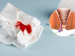 Trĩ ngoại chảy máu