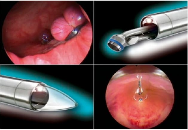 Cách điều trị bằng thủ thuật ngoại khoa