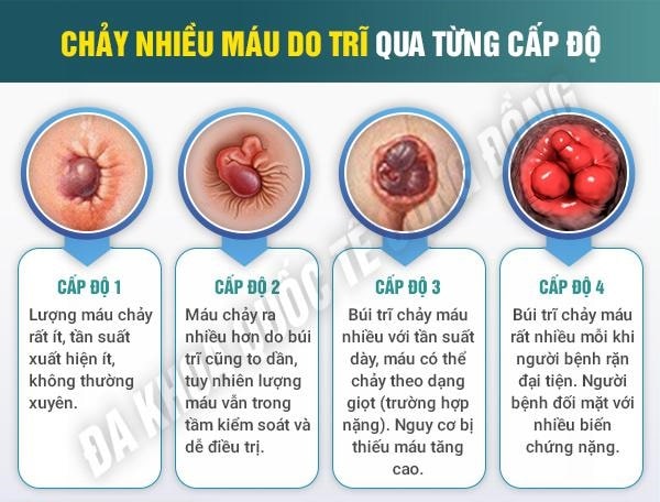 Bệnh trĩ đại tiện ra máu nguy hiểm như thế nào ?