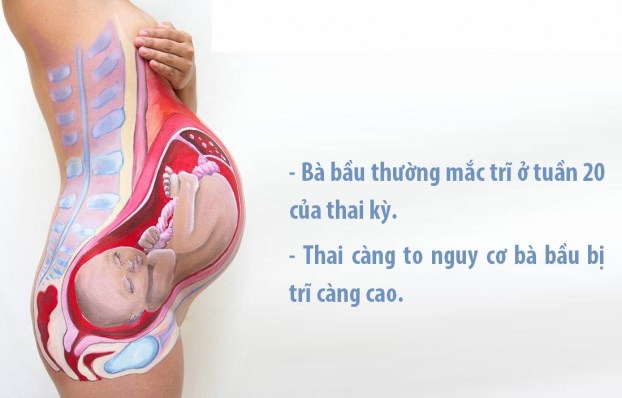 Trĩ khi mang thai xuất hiện giai đoạn nào ?