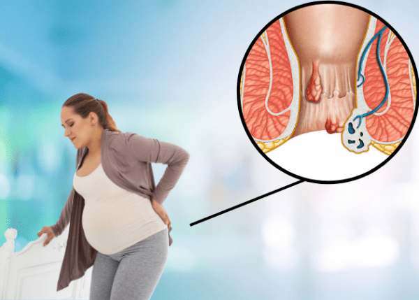 Bệnh trĩ khi mang thai là gì ? Và các dấu hiệu nhận biết điển hình