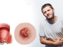 Ảnh hưởng của bệnh trĩ đối với người trẻ tuổi là gì?