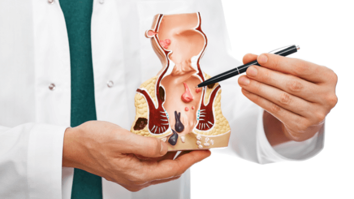 Phát hiện và biện pháp điều trị bệnh trĩ ở người trẻ tuổi