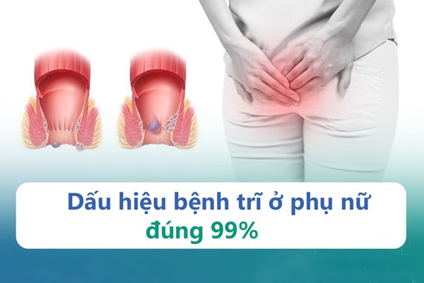 Dấu hiệu nhận biết chính xác bệnh trĩ ở nữ giới