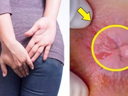 Bệnh trĩ ở nữ giới có nguy hiểm không ? 