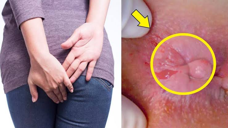 Bệnh trĩ ở nữ giới có nguy hiểm không ?