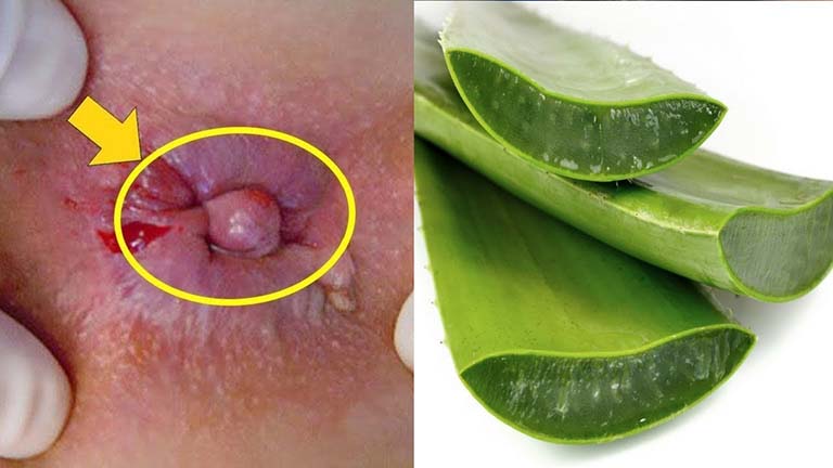 Cách chữa bệnh trĩ tại nhà cho nữ giới