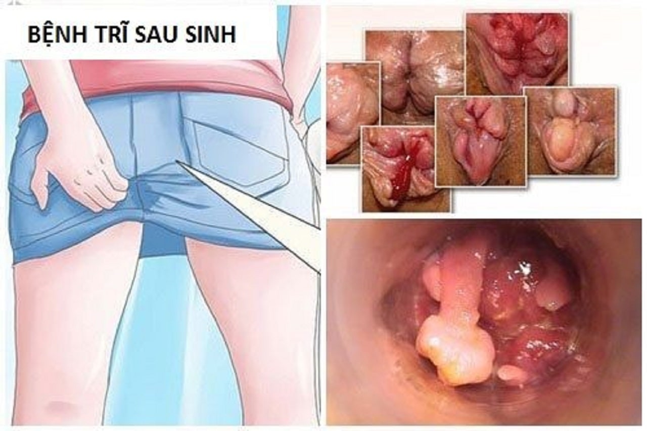 Bệnh trĩ sau sinh liệu có tự khỏi được không?