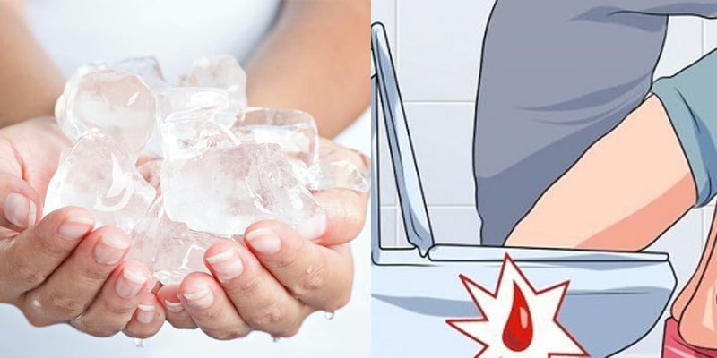 Chườm đá lạnh hậu môn