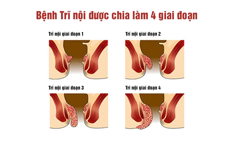 Các triệu chứng phát hiện trĩ nội theo từng giai đoạn
