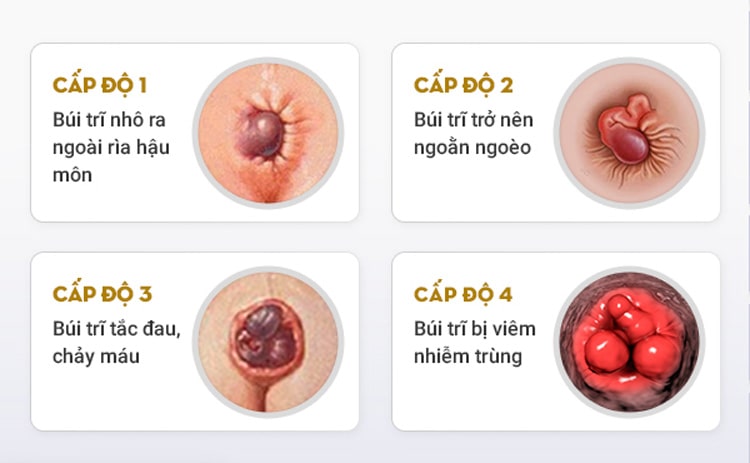 Các triệu chứng phát hiện trĩ ngoại theo từng giai đoạn
