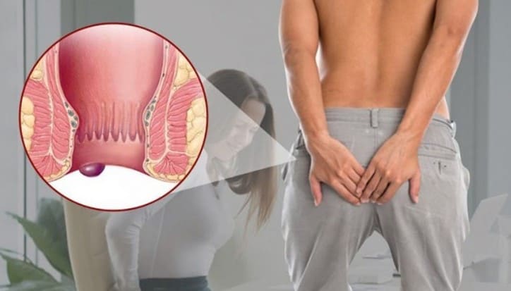 Tại sao cách chữa trĩ ngoại tại nhà lại được ưu tiên lựa chọn?