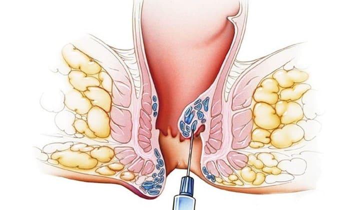 Cách chữa trĩ ngoại bằng phương pháp tiêm xơ trĩ ngoại