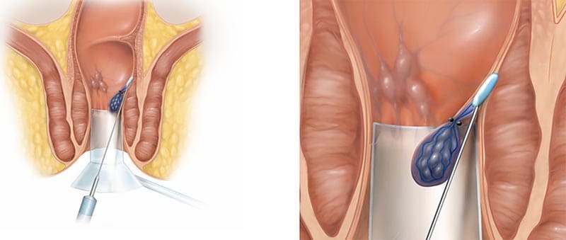 Cách trị trĩ ngoại: Phương pháp thắt búi trĩ ngoại
