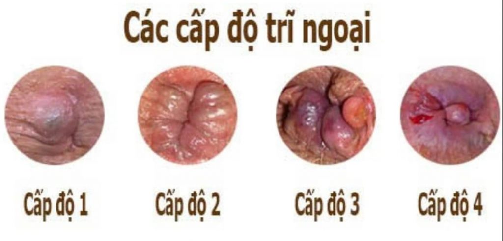 Nhận diện trĩ ngoại thông qua các cấp độ