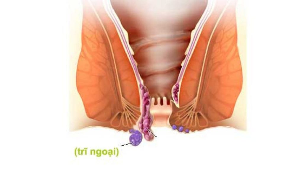 Bệnh trĩ ngoại là gì?