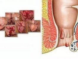 Hình ảnh bệnh trĩ nội