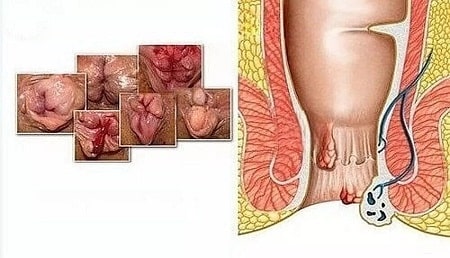 Hình ảnh bệnh trĩ nội