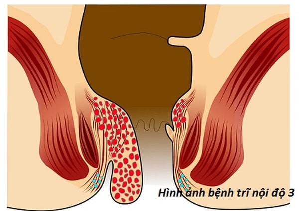 Hình ảnh bệnh trĩ ngoại