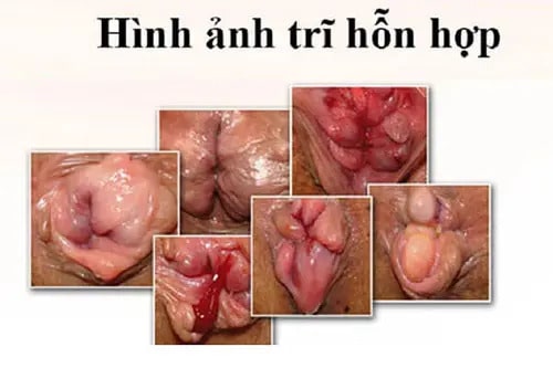 Hình ảnh bệnh trĩ hỗn hợp
