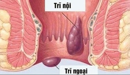 Hình ảnh bệnh trĩ như thế nào ?
