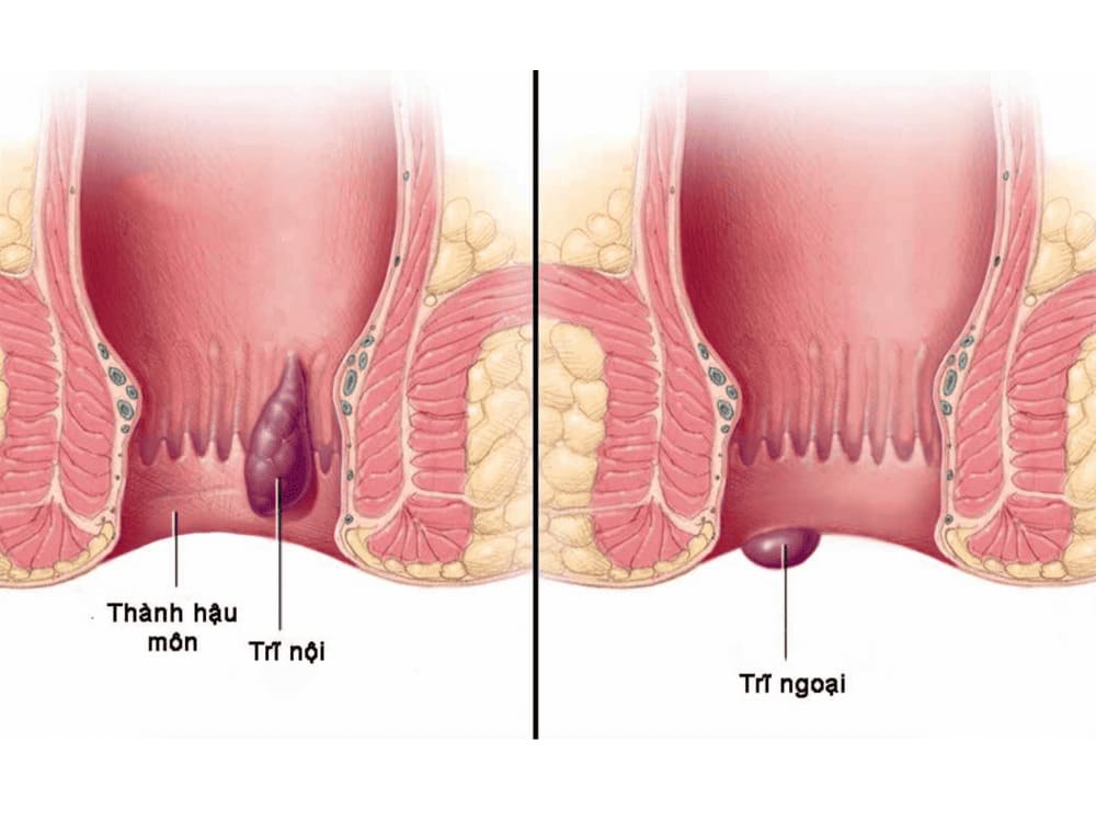 Trĩ ngoại là gì?