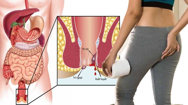 Dấu hiệu nhận biết trĩ ngoại