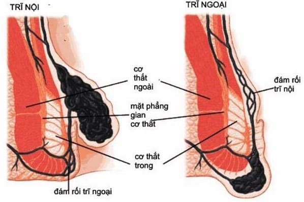 Tắc mạch trĩ