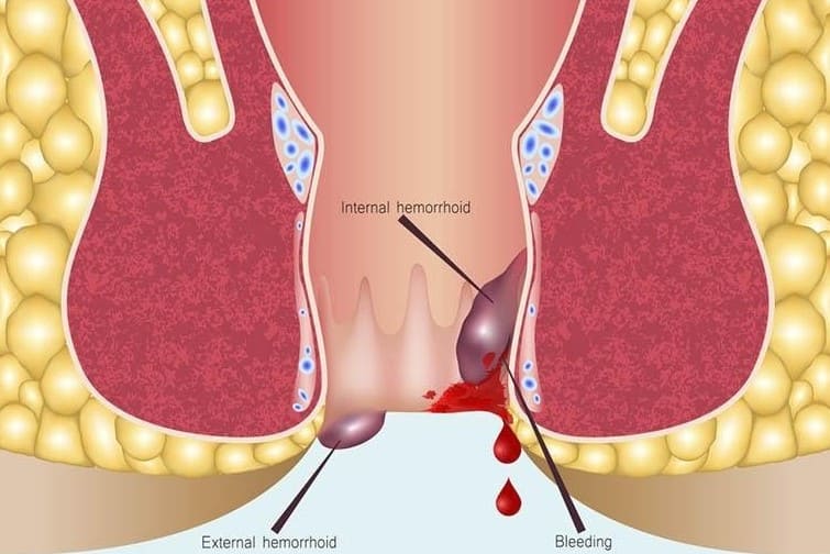 Cụ thể về hiện tượng trĩ ngoại chảy máu