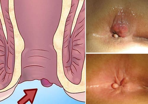 Thông tin tổng quan về bệnh trĩ ngoại