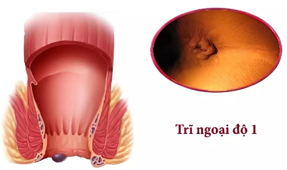 Hình ảnh trĩ ngoại cấp độ 1