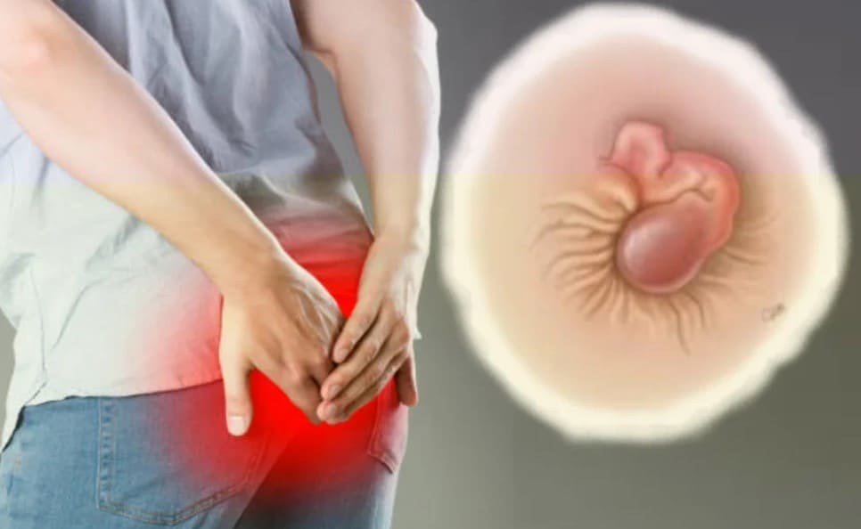 Hình ảnh trĩ ngoại cấp độ 3