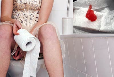 Đại tiện thấy có máu