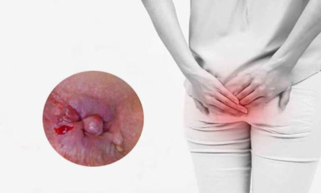 Ngứa ngáy, sưng đau hậu môn