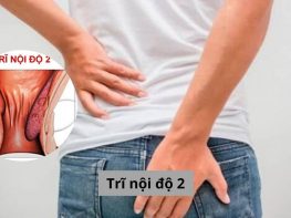 Trĩ nội độ 2