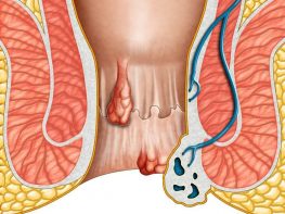 Giới thiệu về bệnh trĩ