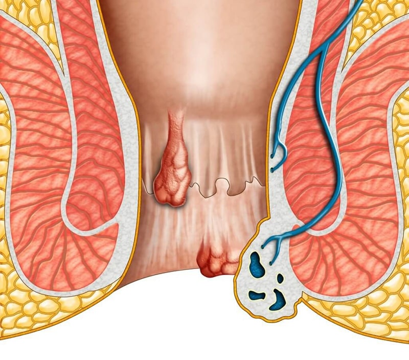 Giới thiệu về bệnh trĩ