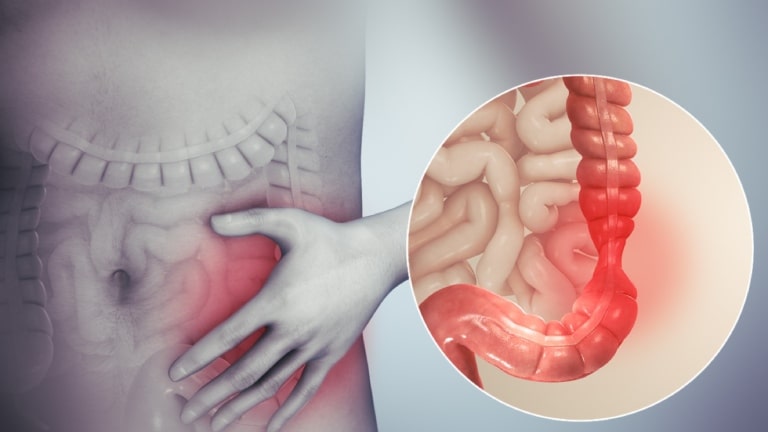 Giúp bạn phân biệt rõ trĩ và ung thư trực tràng