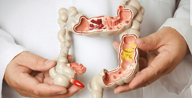 Lý do khiến bệnh trĩ và ung thư trực tràng hay bị nhầm lẫn