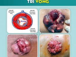 Cơ chế hình thành bệnh trĩ vòng là gì ?