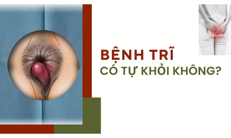 Bệnh trĩ vòng dùng thuốc có khỏi không?