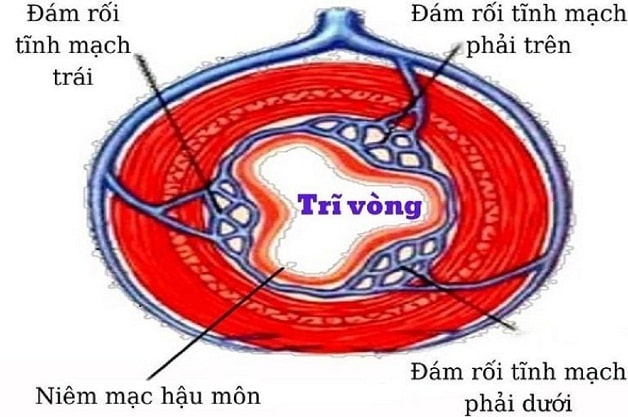 Cụ thể bệnh trĩ vòng là gì ?