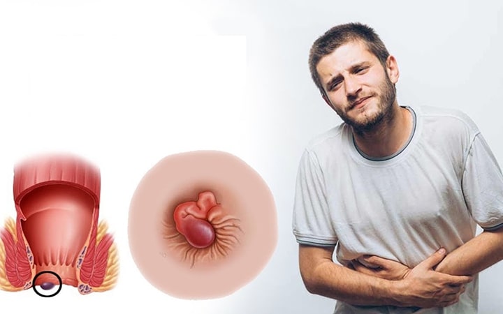 Bệnh trĩ vòng có nguy hiểm không?