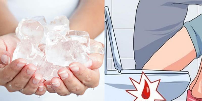 Phòng ngừa tình trạng trĩ nội chảy máu