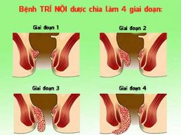 Trĩ nội: Biểu hiện ban đầu