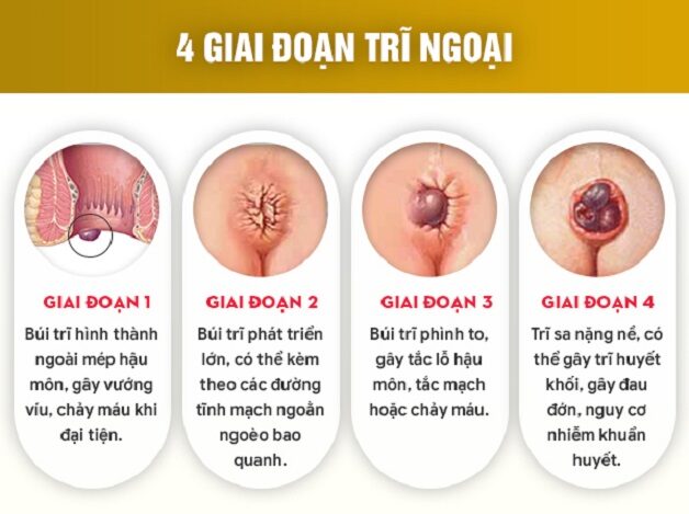Trĩ ngoại: Biểu hiện ban đầu