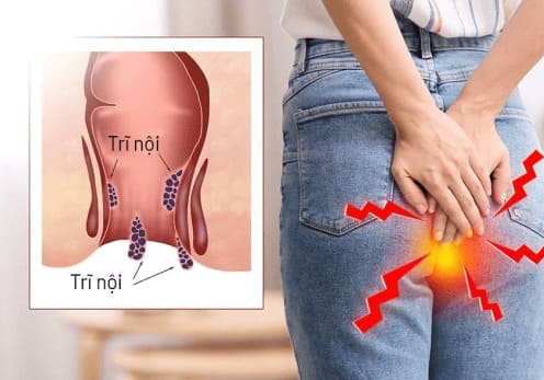 Bệnh trĩ nội là gì?