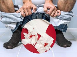 Bệnh trĩ chảy máu có bắt buộc phải điều trị không ?