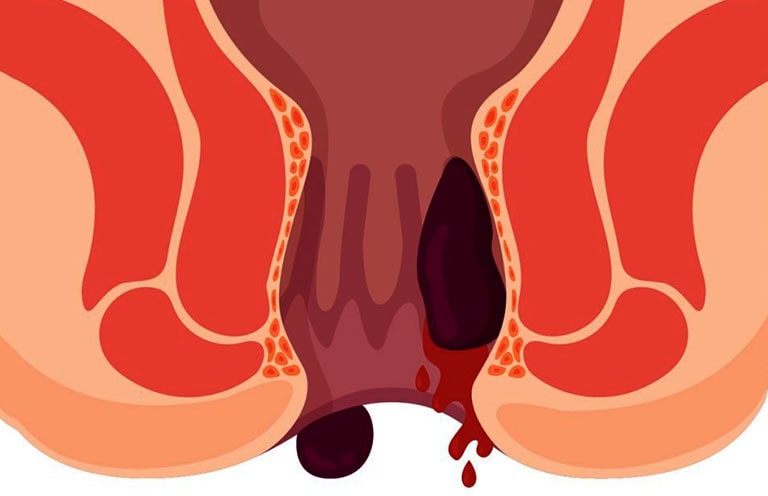 Bệnh trĩ chảy máu là gì ?