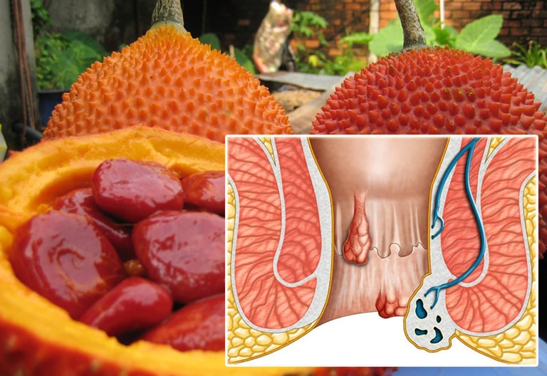Phương pháp dân gian chữa bệnh trĩ bằng hạt gấc
